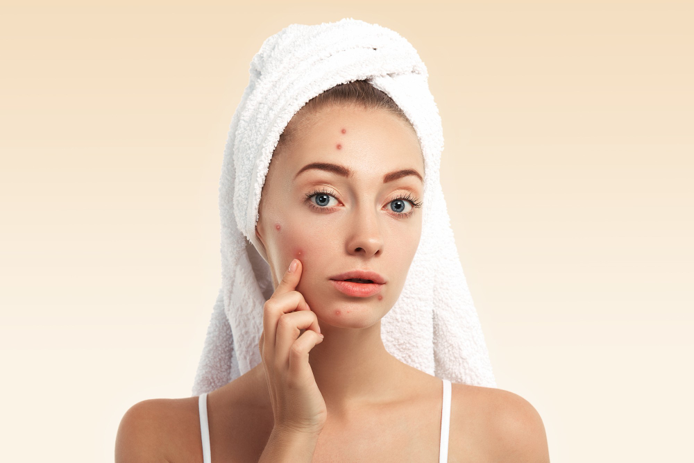 Acne: Causes, Symptoms, and Homeopathic Treatment for Clear, Healthy Skin