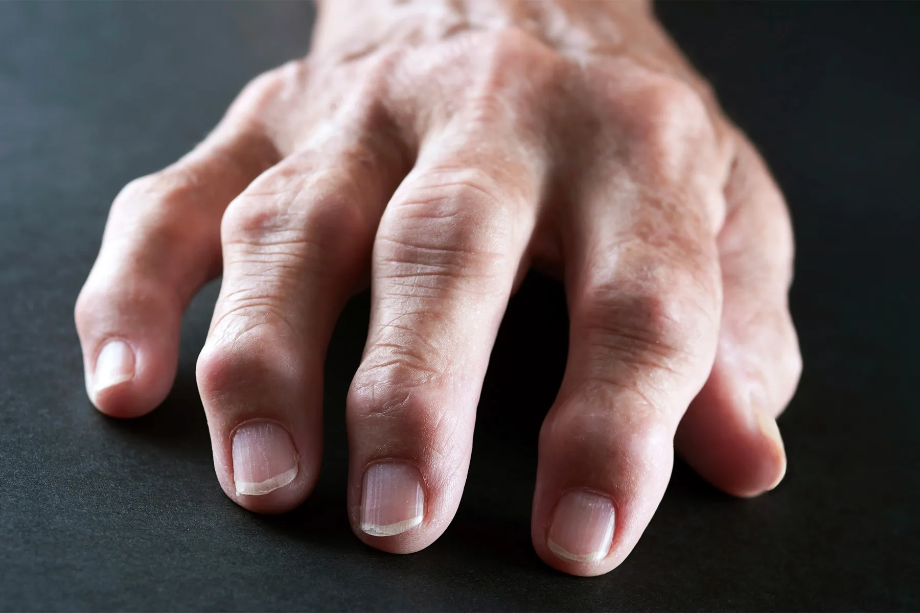 Arthritis: Causes, Symptoms, and Homeopathic Treatment for Effective and Long-Term Relief