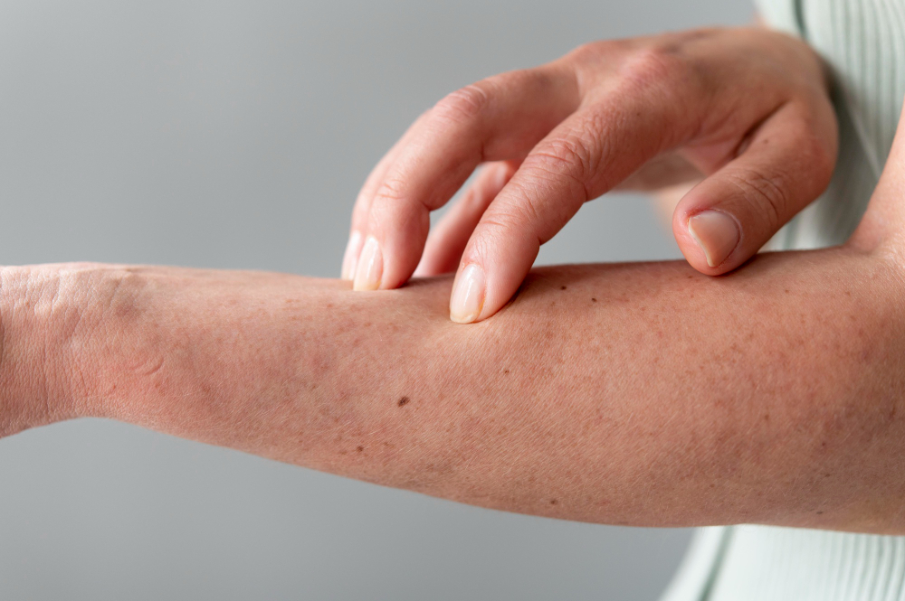 Urticaria: Causes, Symptoms, and Homeopathic Treatment for Lasting Relief