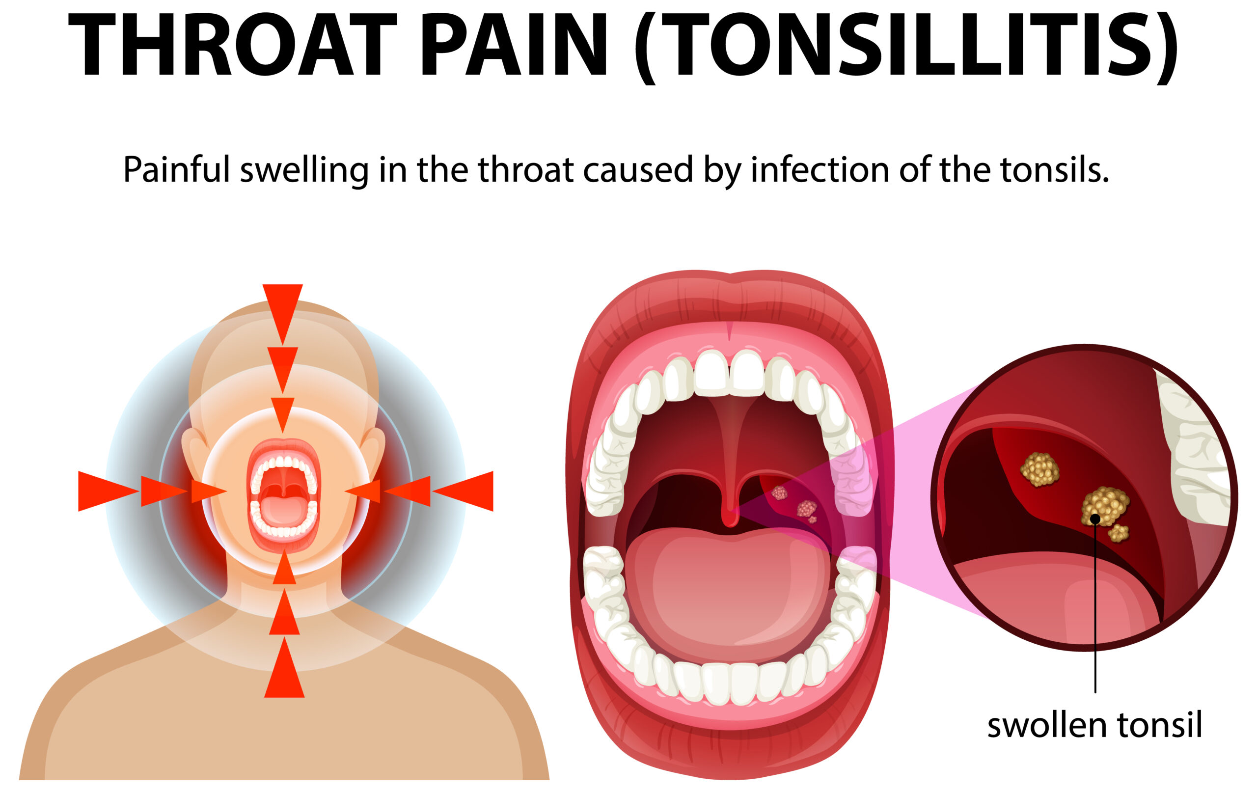 Tonsillitis: Causes, Symptoms, and Homeopathic Treatment for Fast & Gentle Relief
