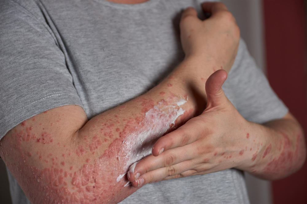 Psoriasis: Causes, Symptoms, and Homeopathic Treatment for Long-Term Relief