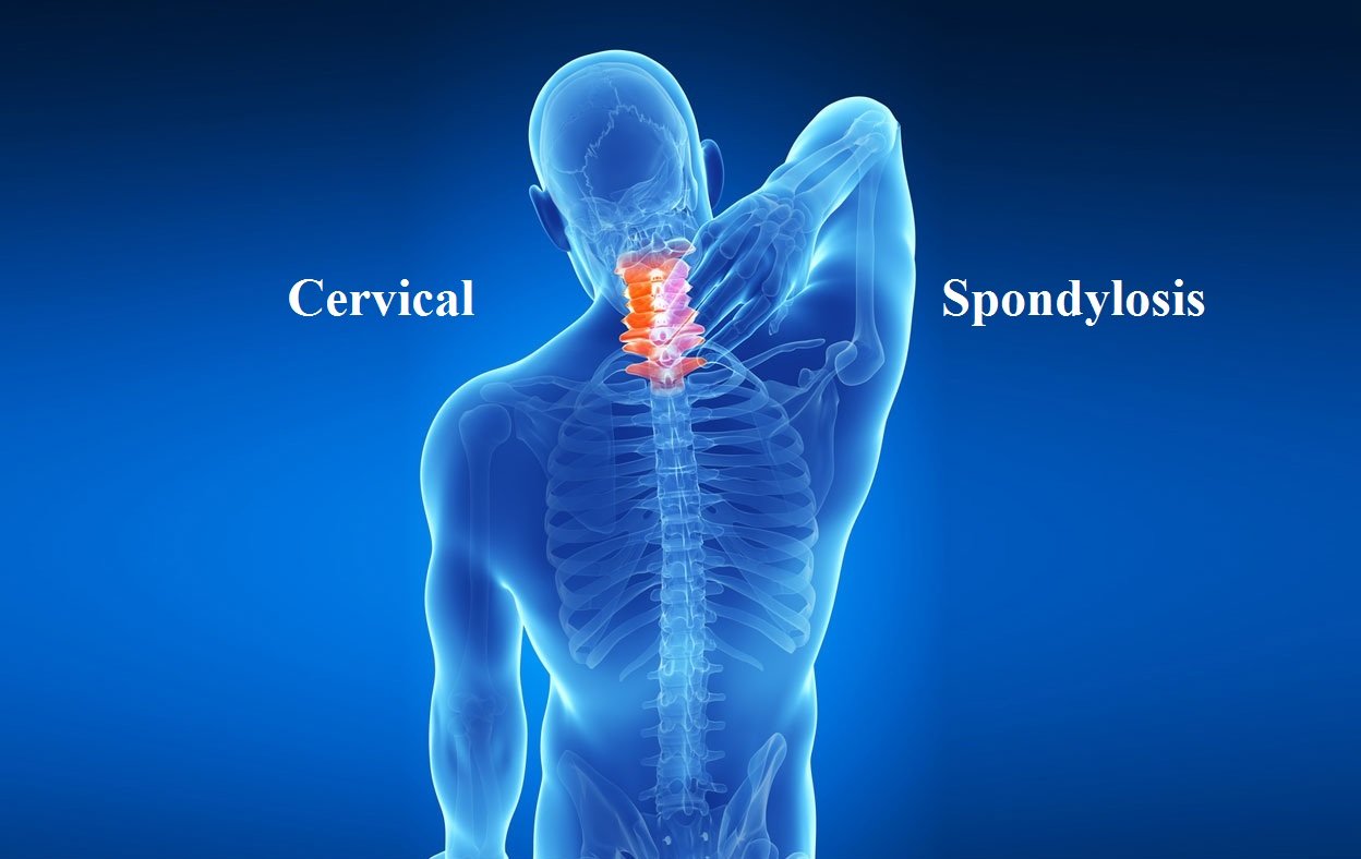 Spondylosis: Causes, Symptoms, and Homeopathic Treatment for Long-Term Relief
